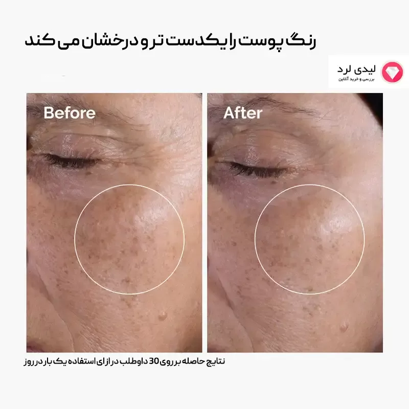 برای بزرگنمایی تصویر دوبار کلیک نمایید تونر گلیکولیک اسید 7% لایه بردار و روشن کننده اوردینری حجم 240 میلی لیتر